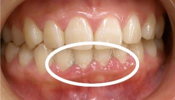 歯周病　ビフォー