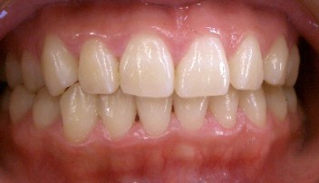 歯周病　アフター