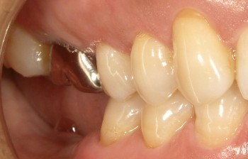 インプラント　前