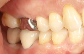 インプラント　後