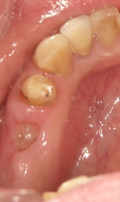 インプラント　前