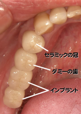 インプラント　後