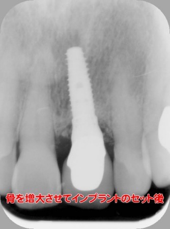 インプラント　後
