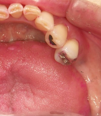 インプラント　前