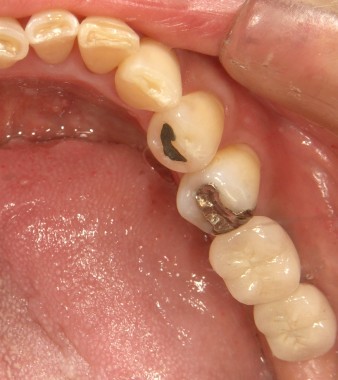 インプラント　後