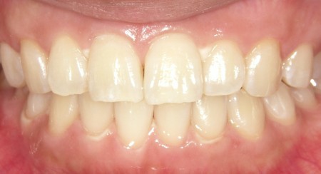 ホワイトニング治療後