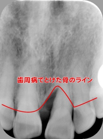 インプラント　前