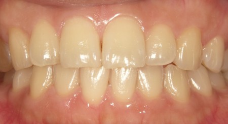 ホワイトニング治療前